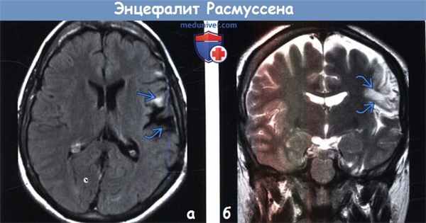Энцефалит Расмуссена на МРТ
