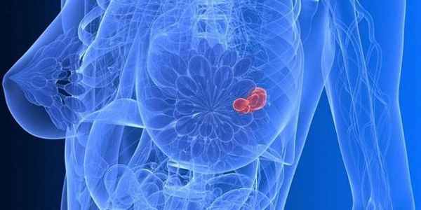 Липома молочной железы