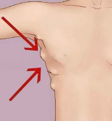 множественный липоматоз