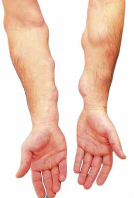 липоматоз на руках