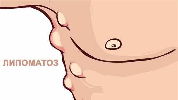 липоматоз фото