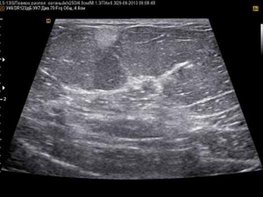 Диагностика липомы молочной железы