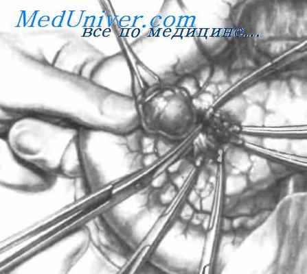 энуклеация инсулиномы