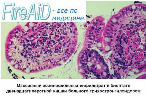 Эозинофилы. Функции эозинофилов. Функции эозинофильных лейкоцитов. Эозинофилия.