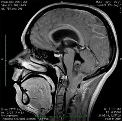 эпендимома