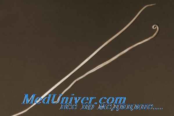 аскаридоз глаз