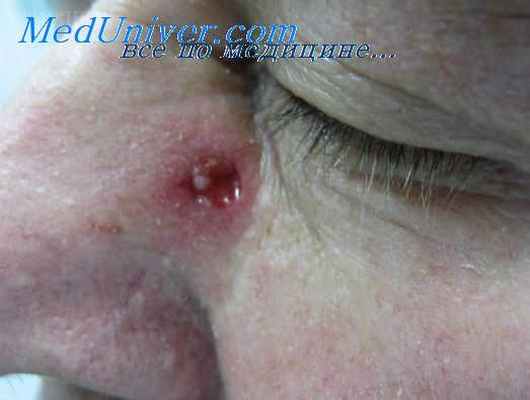 базальноклеточный рак