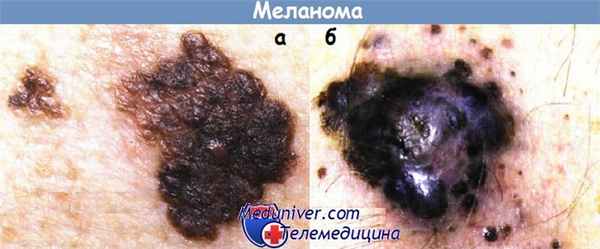 Меланома