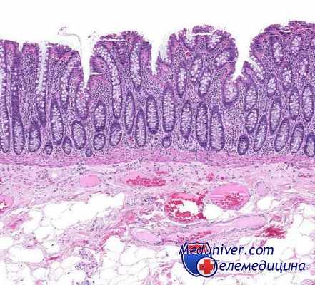 карциноид тонкой кишки
