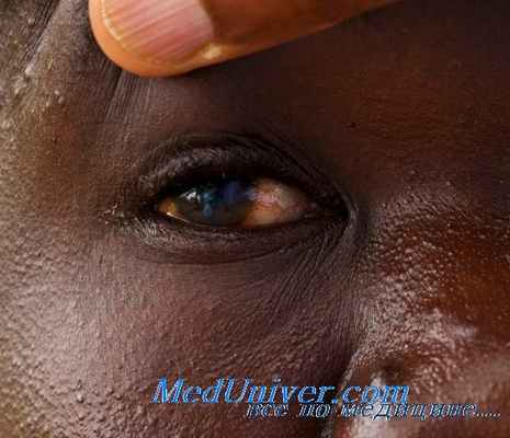 онхоцеркоз глаз