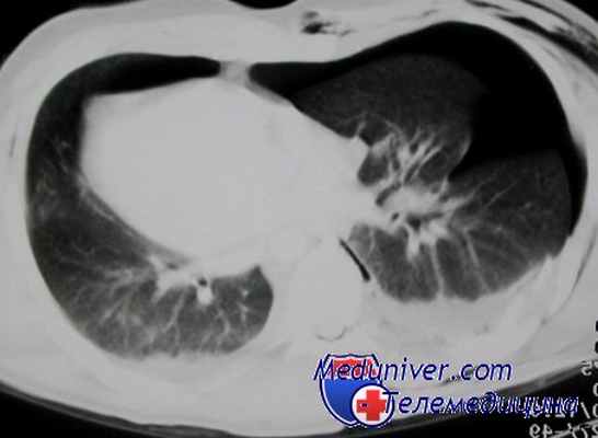 опухоли и кисты средостения