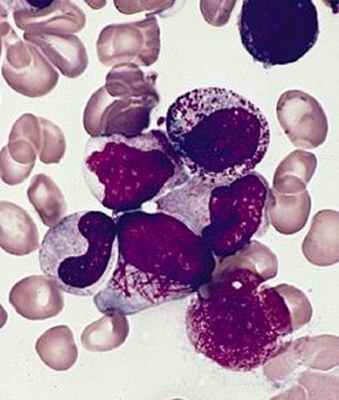 Большинство случаев ОПЛ диагностируют в возрасте от 20 до 60 лет