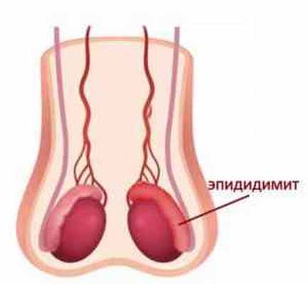 эпидидимит