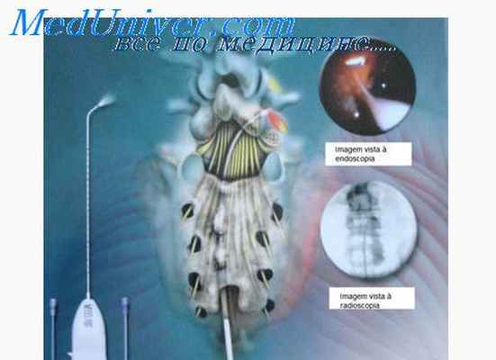 техника эпидуроскопии