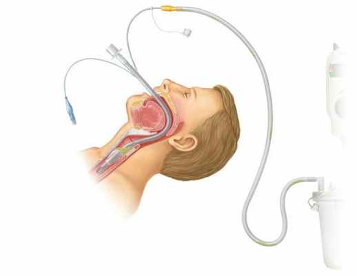 Оротрахеальная интубация 