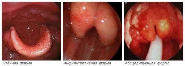 Формы эпиглоттита