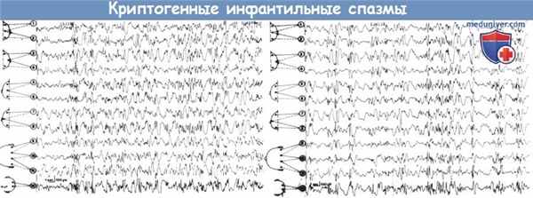 ЭЭГ при криптогенных инфантильных спазмах