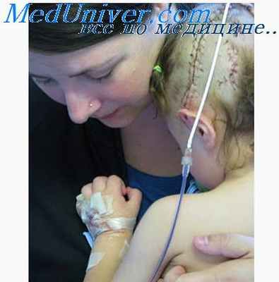 эпилепсия на ээг