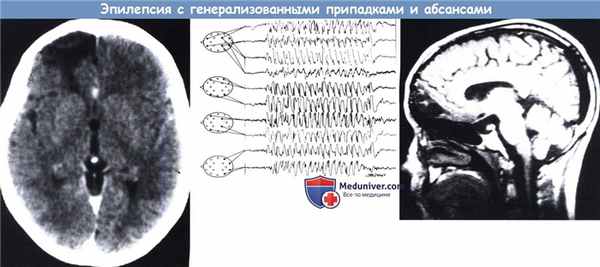 МРТ, ЭЭГ при эпилепсии у ребенка с генерализованными припадками и абсансами