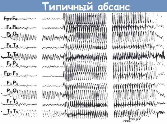 ЭЭГ при типичном абсансе