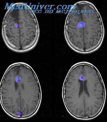 эпилептический очаг