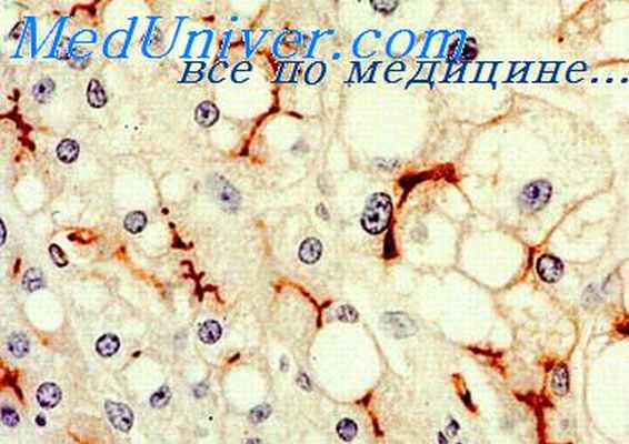 опухоль почки