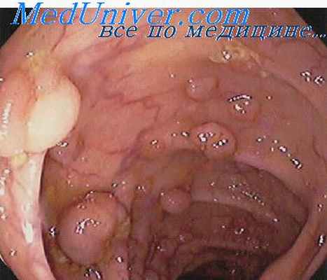 опухоли тонкой кишки