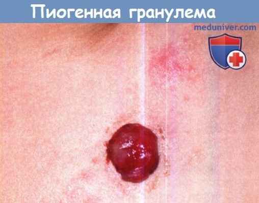 Пиогенная гранулема