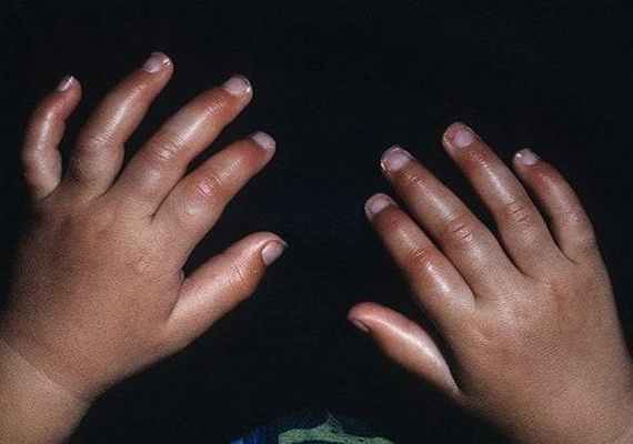 Эритромелалгия, отекшие-палцы