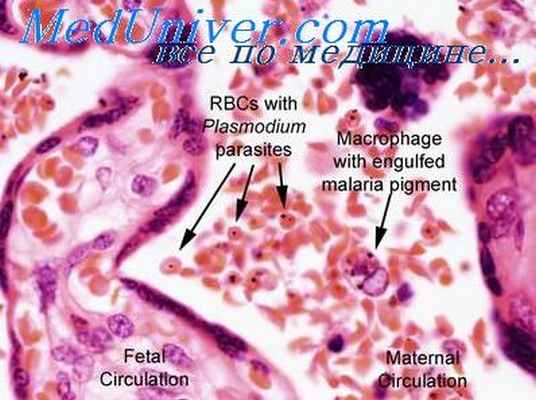 рецидивы малярии