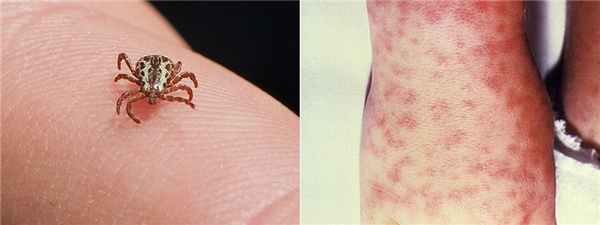 Моноцитарный эрлихиоз человека