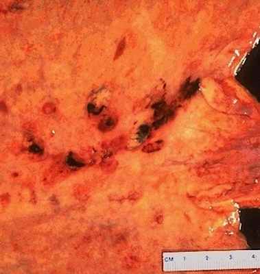 Фото Эрозивный гастрит