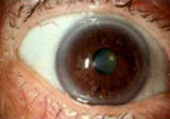 Рецидивирующая эрозия роговицы глаза