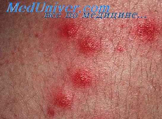 кольцевидная гранулема