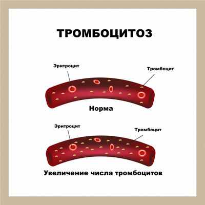 Тромбоцитоз.jpg
