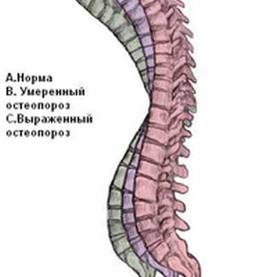 Причины остеопороза