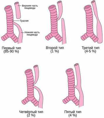 Типы атрезии пищевода