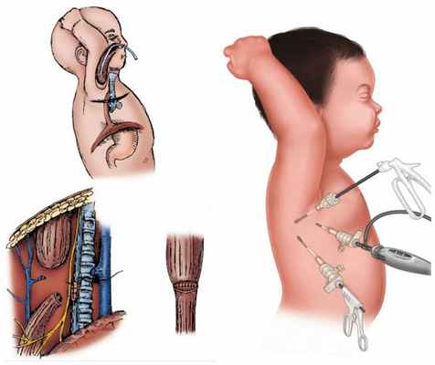 Торакотомия (слева) и торакоскопия (справа)