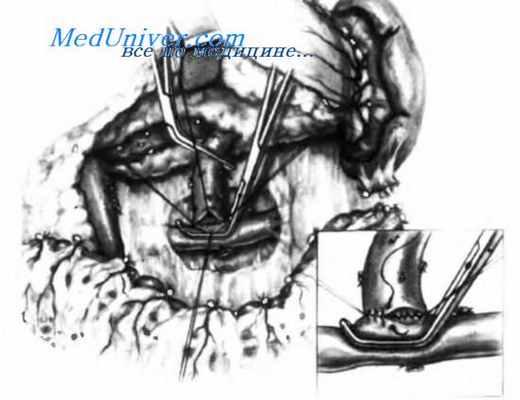 этапы спленоренального анастомоза