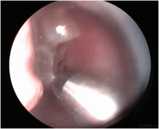 удаления полипов в полости носа