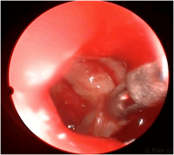 синусит фото удаление полипа из верхнечелюстной пазухи