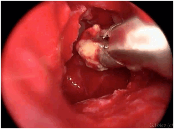 синусит фото удаление пломбировочного материала из верхнечелюстной пазухи