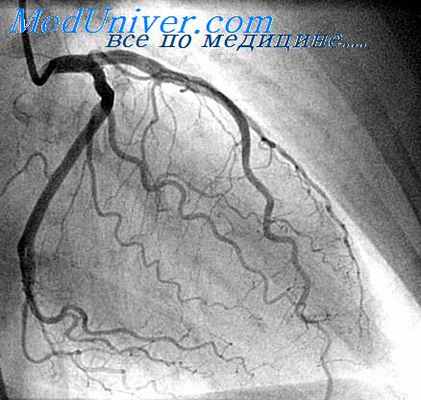 атеросклеротическая бляшка