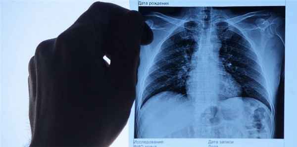 Эхинококкоз