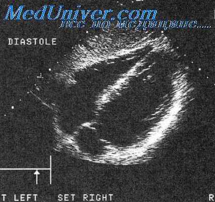 эхоэнцефалография