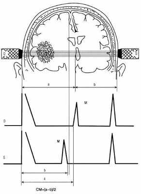график эхоЭГ