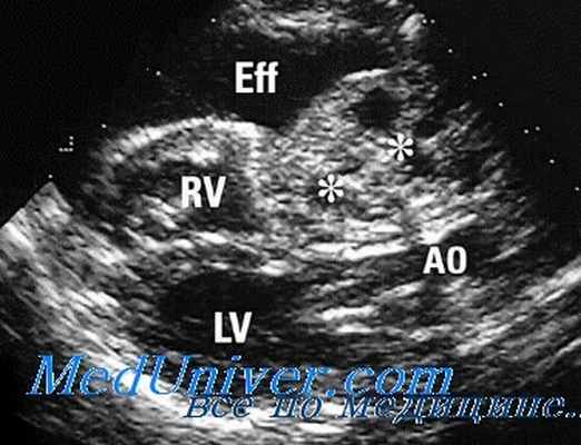 эхокардиография