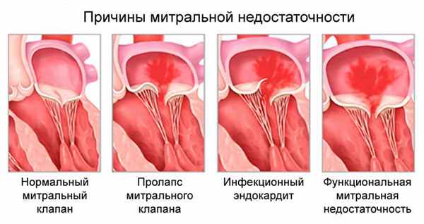 Митральная недостаточность.jpg