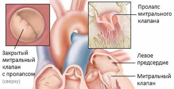 Пролапс митрального клапана