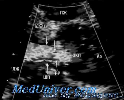 аортальная регургитация